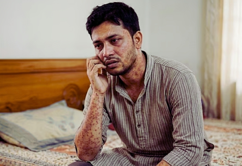 শুধু শিশু নয়, বড়দেরও হাম, অবহেলা হলে বাড়তে পারে প্রাণঘাতী ঝুঁকি!
